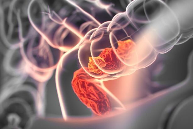 O que pode ajudar a prevenir câncer de intestino?