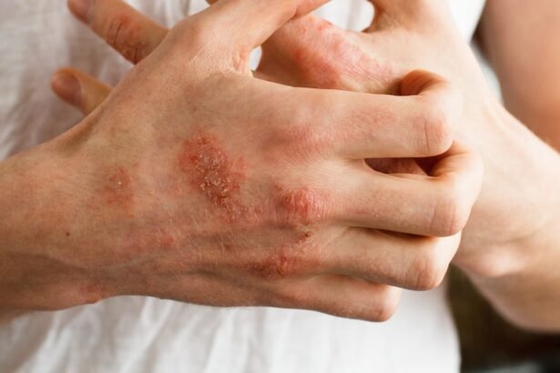 Afinal, o que é eczema? É a mesma coisa que dermatite atópica? Especialistas explicam